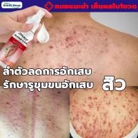 ราคา สเปรย์รักษาสิว ลำตัว ลดการอักเสบ ป้องกันการเกิดใหม่ของสิวสเปรย์รักษาสิวผิวกายสิวหลังช่วยให้สิวอักเสบแห้งพร้อมลดรอยจุดด่า (20338073786)