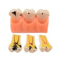 ราคา เครื่องมือทันตกรรมโมเดลฟัน Caries Decomposition Decay (10664953622)
