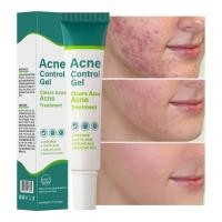 ราคา 30g ครีมแต้มสิว Acne Treatment Skin Cleanser Acne Remover Anti Acne Pimple Marks Remover (52651488733)