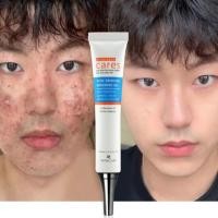 ราคา ครีมกําจัดสิว ครีมลบรอยสิว ผลิตภัณฑ์ดูแลผิว ต่อต้าน สิว การรักษา ใบหน้า เซรั่ม (43008845929)