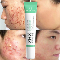 ราคา Salicylic Acid Acne Cream ลบ Blackhead Oil Control Anti Acne Treatment Repair สิวรอยแผลเป็น Whitening Face Cream Skincare (16941827020)