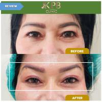 ราคา E Voucher KPB Clinic ร้อยไหม Foxy eye 4 เส้น (20834378019)