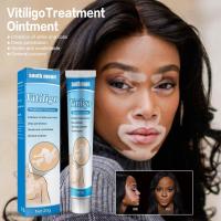 ราคา ส่งฟรี South Moon ยาด่างขาว โรคด่างขาว โรคผิวหนัง ผลิตภัณฑ์กระตุ้นการสร้างเม็ดสีของผิว ยารักษาด่างขาว ผลิตภัณฑ์ Vitiligo (18573633032)