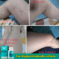 ราคา balance Ucore อาหารเสริม ช่วยเรื่อง ผื่นภูมิแพ้ ผื่นน้ำเหลืองเสีย ผิวอักเสบ สะเก็ดเงิน เซ็ทเดิร์ม (20480951844)