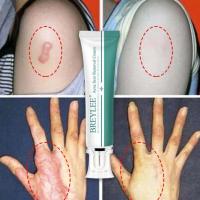 ราคา breylee ของแท้ คลีมทาแผลเป็น ครีมลบรอยแผลเป็น ครีมทาแผลเป็น scar gel ครีมรอยสิว เหมาะกับผิวบอบบาง scar cream (15014879160)