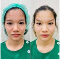 ราคา E Voucher KPB Clinic ร้อยไหม Foxy eye 6 เส้น (20834420080)