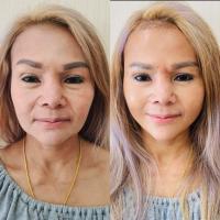 ราคา E Voucher KPB Clinic ร้อยไหมยกกระชับหน้า ไม่จำกัดเส้น ฟิลเลอร์ใต้ตา2cc ฟิลเลอร์ร่องแก้ม2cc ของแถม4รายการ (20545917384)