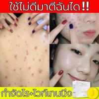 ราคา สบู่ลดสิวหน้า สบู่กำจัดไรสิว ไวท์เทนนิ่ง สบู่ป้องกันแบคทีเรีย สบู่กำจัดสิว สบู่ลดสิวหลัง สบู่ลดสิวหลัง สบู่อาบน้ำ สบู่สูตรลับโสม สบู่ล้างเครื่องสำอางค์ สบู่หน้าเงา สบู่ก้อน สบู่ล้างหน้า 100g (15924673