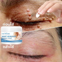 ราคา ครีมขจัดกระไฝหูดทำความสะอาดผิว ครีมขจัดไฝไม่เจ็บปวด เซรั่มฝ้า ฉลากใบหน้า การรักษากระไฝหูด (19718158998)