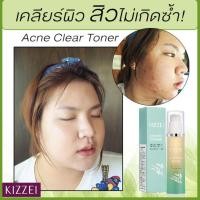 ราคา ลดสิวอุดตันกระชับรูขุมขน Kizzei Acne Toner ละลายสิวอุดตัน ลดหน้ามัน กระชับรูขุมขน ลดสิวอุดตันสิวผด ของแท้ ส่งไว (2398680340)