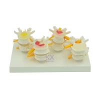 ราคา กระดูกสันหลังเอวมนุษย์สี่ขั้นตอนสุขภาพโรคพยาธิวิทยาโรคโรคอายุ-การแขวนโรคกระดูกสันหลัง-การแขวนแผ่นดิสก์โอสเตโอโพโรซิส หนึ่งต่อหนึ่ง (41213117099)