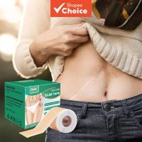 ราคา ซื้อ 2 แถม 1 - แผ่นปิดแผลเป็นซิลิโคน เทปซิลิโคนปิดแผลเป็น สําหรับผ่าตัด แผลเป็น แผลผ่าตัด อุบัติเหตุ ไหม้ แผลศัลยกรรมหน้าท้อง (43877106307)