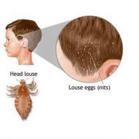 ราคา กำจัดเหาแชมพูกำจัดเหา ทำลายเหาทั้งหมด ยาฆ่าเหาใช้สูตรอ่อนโยนไม่ระคายเคือง เหมาะสำหรับเด็กและสตรีมีครรภ์ (41867570660)