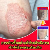 ราคา โรคสะเก็ดเงิน, โรคผิวหนัง, ครีมรักษาโรคงูสวัด, ครีมรักษาโรคสะเก็ดเงิน, รอยแดง, โรคผิวหนัง, โรคกลาก, โรคผิวหนังอักเสบ, อาการคัน, สมุนไพร, อาการคันเรื้อรัง, อาการคันบริเวณขาหนีบ. (43152157903)