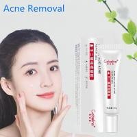ราคา GEBOLINE ครีมแต้มสิว 15% Azelaic Acid Acne Cream Naturally Moisturizing to Acne Marks Repair Acne Pit Skin Care ครีมแต้มสิว Face Care M171 (25683238898)