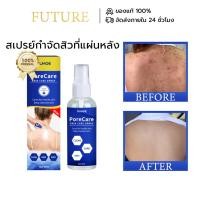 ราคา OUHOE สเปรย์กำจัดสิวที่แผ่นหลัง สเปรย์ลดสิว แผ่นหลัง และลำตัว สิวที่หลัง แอคเน่ กำจัดสิวที่หลังและลำตัว สเปรย์ฉีดสิว (42062360993)