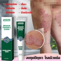 ราคา แก้คัน อบรรเทาอาการคันผิวหนัง ครีมเฉพาะที่ 20g สะเก็ดเงิน ครีมทาบรรเทาอาการคัน ครีมกลากเกลื้อน กลาก สังคัง ครีมบำรุงผิว (26611395637)