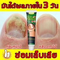 ราคา อ่อนโยน ยารักษาเชื้อราเล็บ ครีมบำรุงเล็บ ช่วยฟื้นฟูเล็บที่เปราะบาง ให้เล็บแข็งแรง ดูสุขภาพดี ซึมไว ใช้ง่าย (55859613123)