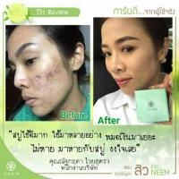 ราคา Neem Bright & Clear Acne Soap สบู่ออร์แกนิค สบู่นีม สบู่รักษาสิว สบู่สิวหลุด neem natural (8114401626)