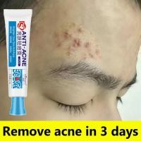 ราคา 00%วาลิดไวท์แอคเน่ครีมบํารุงผิว ItchyCareCreamSkinCarePimplEraserAcneTreatmentCreamAcneRepairCreamOriginal (46710968194)