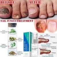 ราคา ของแท้ 100 AuQuest ซ่อมแซมเล็บ บำรุงเล็บ รักษาเชื้อราที่เล็บ รักษาเล็บขบ เล็บเปราะ เล็บอ่อนแอ เล็บฉีก เซรั่มบำรุงเล็บ น้ำมันบำรุงเล็บ ครีมเล็บกำกัดเชื้อรา เล็บแตก Fungal Nail Treatment Repair Essence