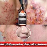 ราคา BEILINGMEI 100ml ดูดซับอย่างรวดเร็ว ครีมลดสิว เจลรักษาสิว ครีมกำจัดสิว ครีมแต้มสิว ครีมรักษาสิว ครีมลดรอยสิว สิวอุดตัน ครีมทาสิว เจลแต้มสิว สิวผด รอยดำจากสิว รอยแดง ลบรอยสิว เซรั่ม (16276064831)