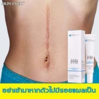 ราคา ลบรอยแผลเป็นโดยไม่ทิ้งรอย SKINEVER ครีมทาแผลเป็น ซ่อมแซมรอยแผลเป็นการผ่าตัด แผลไฟไหม้น้ำร้อนลวก ครีมซ่อมแซม ครีมทาแผลรอยดำ ครีมลบแผลเป็น เจลลบรอยแผลเป็น ครีมลดรอยแผลเป็น ยาลบลอยแผ (9877018400)