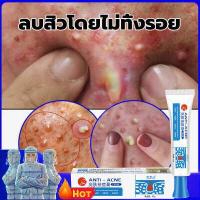 ราคา แพทย์แนะนําใช้ ANTI ครีมลดสิว ครีมรักษาสิว 25gซ่อมแซมผิวให้เรียบเนียนมากขึ้น ครีมทาหลุมสิว ครีมลดสิว เจลรักษาสิว ครีมรักษาสิว ครีมแต้มสิว เซรั่มลดสิว ครีมกำจัดสิว ดูดซับความมันส (17030916827)