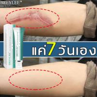 ราคา ซื้อ2 แถม 1 breylee ครีมลดรอยแผล ครีมลบแผลเป็น แผลเป็นนูน ฮีรูดอยแผลเป็น ยาทาแผลเป็นนูน ครีมลบรอยแผลเป็น ครีมทาแผลเป็น รอยแตกลาย รอยสิว ครีมรอยสิว เหมาะกับผิวบอบบาง scar cream คลีมทาแผลเป็น ครีมลบรอย 