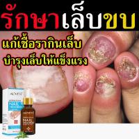 ราคา พร้อมส่ง สมุนไพร แก้เล็บขบ 1 ขวด เชื้อราในเล็บ ยารักษาเล็บขบ ยาแก้เล็บขบ เซรั่มเล็บขบ ทาเล็บขบ (9483652171)