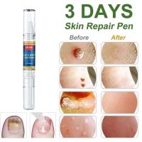 ราคา ทดลองใช้ฟรี 7 วัน Thailand Spot ส่งที่ประเทศไทย ทาไฝ ไฝ ไฝ ขี้แมลงวัน แต้ม หูดตาปลาและติ่งเนื้อไฝ COD ผลิตภัณฑ์ไฝ ขี้แมลงวัน ครีมกำจัดขี้แมลงวัน กำจัดไฝ ยากำจัดใฝ กำจัดขี้แมงวัน skin tag remover mole 