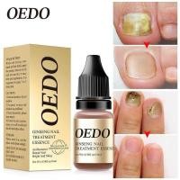 ราคา OEDO FDA รักษาเชื้อราเล็บ ยาทาเชื้อราเล็บ เชื้อราที่เล็บ รักษาเล็บ เชื้อราที่เล็บ รักษาเล็บขบ ฆ่าเชื้อราที่เล็บ (22300034214)
