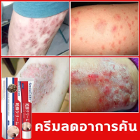 ราคา ครีมลดอาการคัน 20g ยาทาแก้คัน แก้คัน ตุ่มเหงื่อ ผื่นผิวหนัง อับชื้น ผด ครีมทาภายนอก ครีมลดอาการคัน ทาแก้คัน ผิวหนังทากากเกลื้อน สารสกัดจากพืชใช้ได้ทั้งตัวบอกลาผิวคันได้ง่ายๆ psoriasis cream (230433204