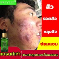 ราคา BREYLEEเซรั่มทาสิว17mlครีมลดสิว สิวอุดตัน สิวผด ไม่มีหัว หลุมสิว รอยดำจากสิว รอยแดง ครีมแต้มสิว เจลทาสิว เจลแต้มสิว ครีมกำจัดสิว ครีมทาสิว เจวแต้มสิว ครีมสลายสิว ครีมทาสิวต่างๆ ครีมทารอยสิว เซรั่มทารอ