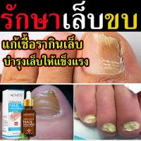 ราคา พร้อมส่ง สมุนไพร แก้เล็บขบ 1 ขวด เชื้อราในเล็บ ยารักษาเล็บขบ ยาแก้เล็บขบ เซรั่มเล็บขบ (9483525706)