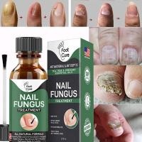 ราคา EXTRA STRONG Nail Fungus Treatment Best Nail Repair Stop Fungal Growth Effective Fingernail Toenail Health Care Solution Fix Renew Damaged Broken Cracked Discolored Nails (15259827165)