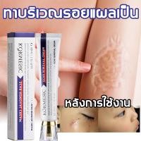 ราคา รอยแผลเป็น รอยแผลเป็น ครีมลบรอยแผลเป็น ครีมทาแผลเป็น แผลไฟไหม้ รอยสิว ครีมทาแผลเป็น ครีมลบรอยแผลเป็น ลบรอยแผลเป็นเก่าที่ขา Scar cream (24598552486)