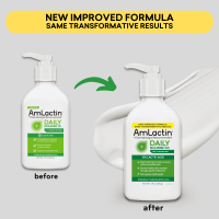 ราคา Improved formula AmLactin Daily Moisturizing Body LotionAmlactin Daily 12 Lactic Acid Moisturizing Lotion โลชั่นบำรุงผิว ลดการเกิดขนคุด (19511524136)