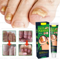 ราคา JiuJiu 7Days Effect Fungal Nail Treatment Serum Essence Cream Feet Nails Repair Solution Anti Infection Cream Toe Fungal Removal (23305741408)