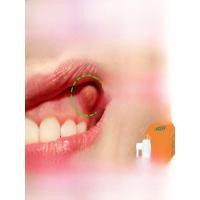 ราคา ยาสเปรย์เฉพาะสำหรับแก้ปวดฟันและผิวหนังบริเวณเหงือกอักเสบ ยาฆ่าเชื้อแบคทีเรีย ลดอาการอักเสบ บรรเทาอาการเจ็บปวด ฟันผุ (24020035189)