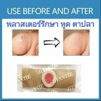 ราคา กำจัดหูด ตาปลา แผ่นแปะรักษาหูดและตาปลา แผ่นละ 2 บาท พลาสเตอร์รักษาหูด ตาปลา (3838251857)