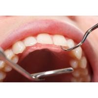 ราคา ที่ขูดหินปูนด้วยตัวเอง เครื่องมือขูดหินปูนทำด้วยสแตนเลสแท้ ใช้ขูดฟันมีหินปูนเกาะ ฟันมีคราบหินปูน (1727753702)