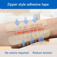 ราคา แผ่นปิดแผลไม่ต้องเย็บแผล แผ่นช่วยรักษาแผลผิวหนัง แผ่นปิดแผลแบบซิป แผ่นปิดแผลใช้แล้วทิ้ง (26090486670)