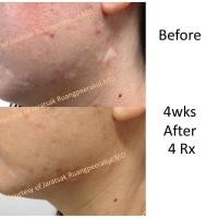 ราคา สบู่ออนเซ็น สิว ฝ้า สบู่สำหรับผิวแพ้ง่าย แพ้กรดผลไม้ (769994246)