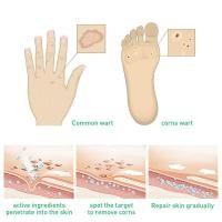 ราคา แปะตาปลา ตาปลา แผ่นแปะตาปลา พลาสเตอร์ตาปลา พลาสเตอร์ติดตาปลา เห็นผลดีเมื่อใช้ต่อเนื่อง หายจริง (27856098551)