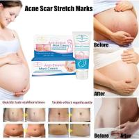 ราคา ครีมทาขาแตกลาย ครีมทาท้องลาย ครีมทาก้นดำลาย ครีมทาขาลาย ครีมทาผิว คลีม ครีมทารอย ครีมทาแตกลาย ครีมลดลอยเเตก ครีมลดรอยแตก (42867332283)