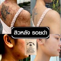ราคา สบู่ใบชารักษาสิวหลัง ใบหน้า หน้าอก สูตรแพทย์แผนไทย สบู่รักษาสิวผด สบู่รักษารอยดำสบู่รักษารอยแดงสบุ่รักษาสิวที่หน้า (13067465147)