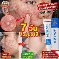 ราคา เจลแต้มสิว เจลแต้มสิวอักเสบ ครีมแต้มสิว รักษาสิว แต้มสิว ยาแต้มสิว ยาแต้มสิวอักเสบ ละลายหัวสิว สิวผด สิวอุดตัน (54813534805)